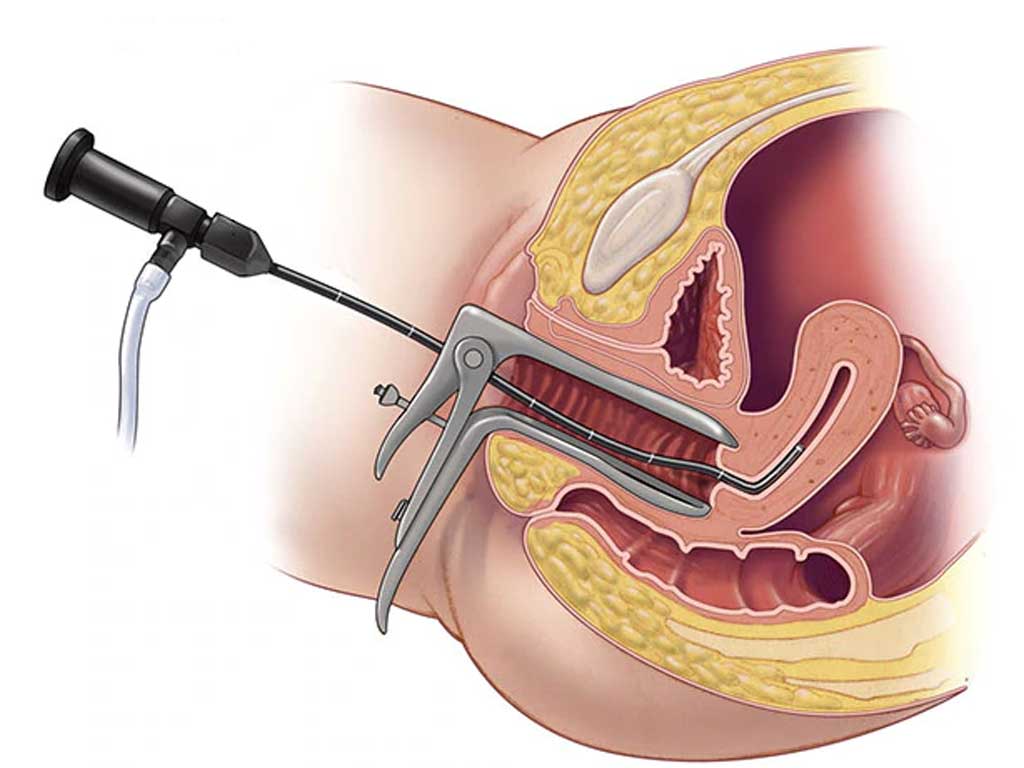 histeroscopia diagnóstica