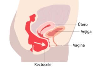 Prolapso vaginal posterior