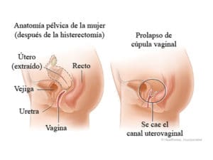 Prolapso de cúpula vaginal