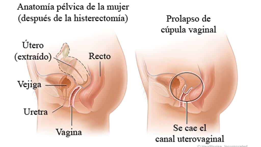 Prolapso de cúpula vaginal