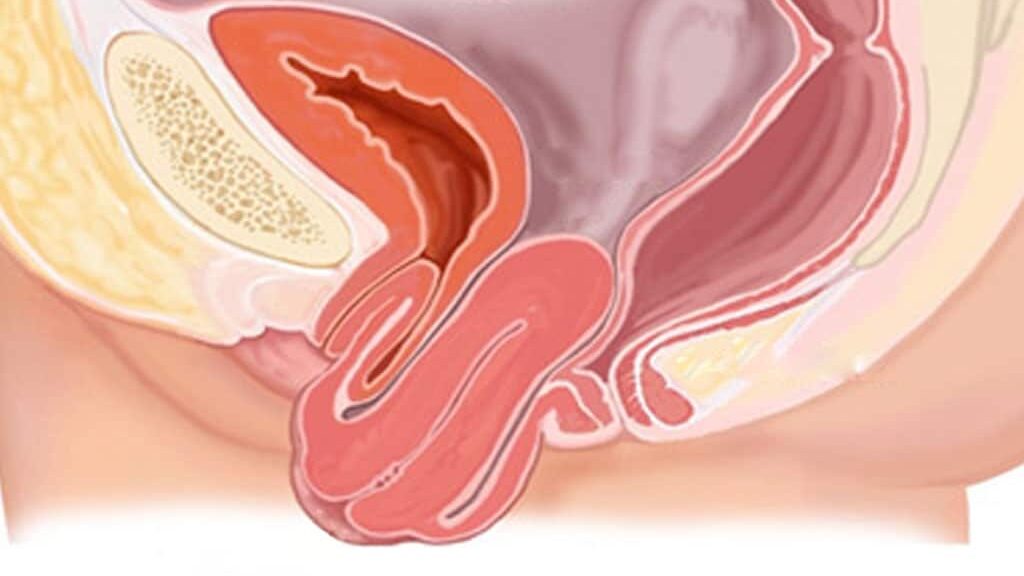 Prolapso Uterino