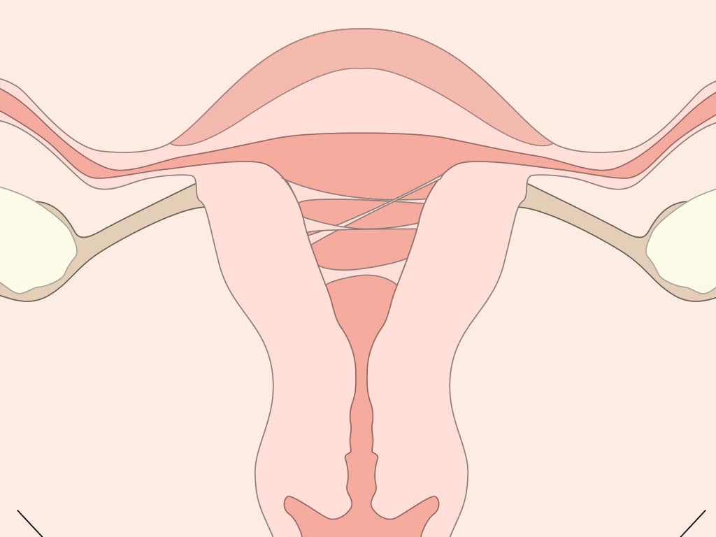 Síndrome de Asherman