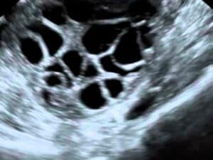 Ovario Poliquístico