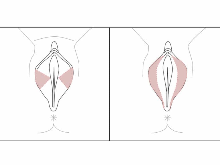 Técnica labioplastia