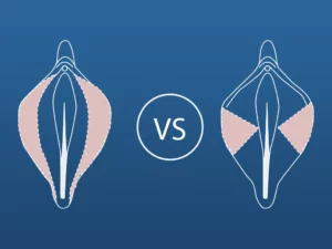 trim vs wedge