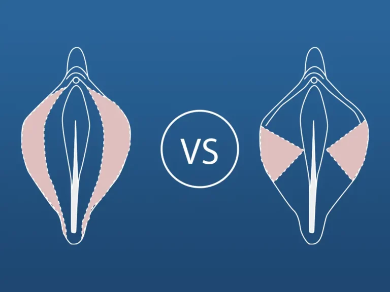 trim vs wedge